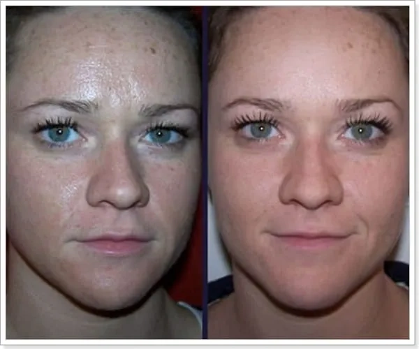 Ультразвуковая терапия фото до и после
