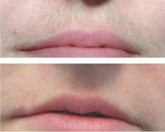фотоэпиляция верхней губы фото до и после