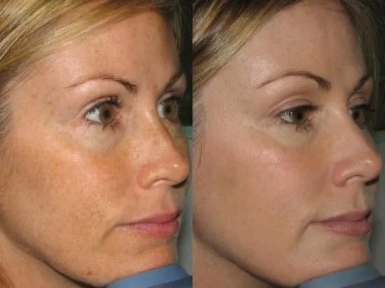 Аппаратная косметология фототерапия лица фото до и после