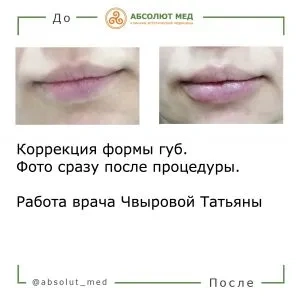 Фото до и после процедуры увеличения губ
