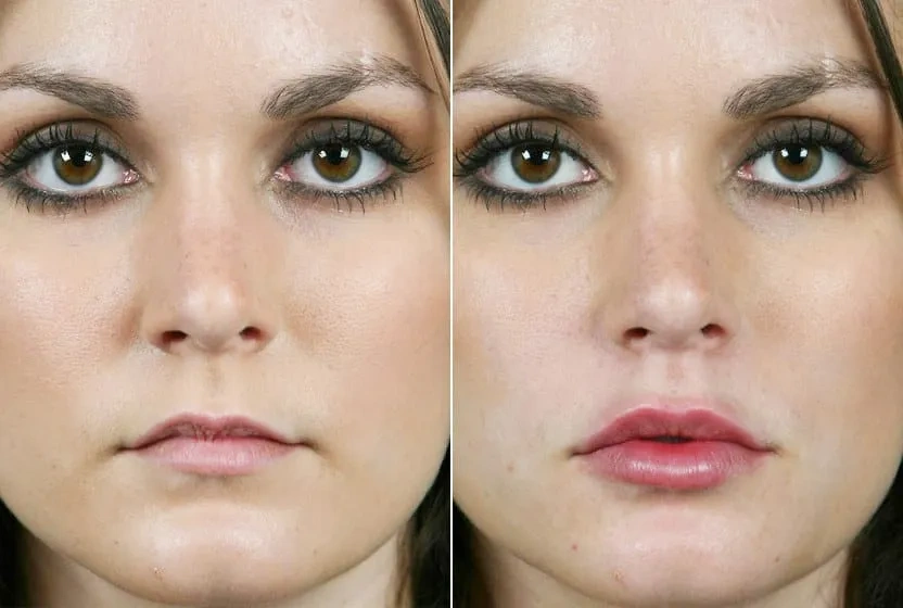 фото до и после введения препарата в губы