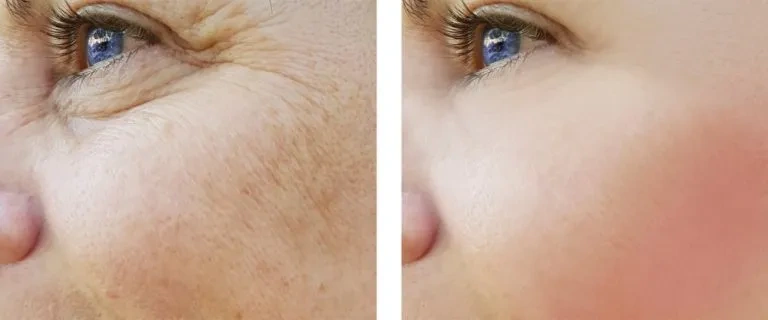 фото до и после лазерной шлифовки лица
