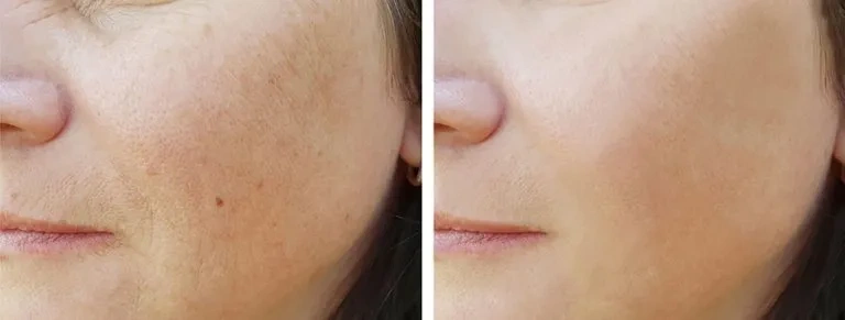 фото до и после лазерной шлифовки лица