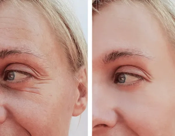 фото до и после лазерной подтяжки лица