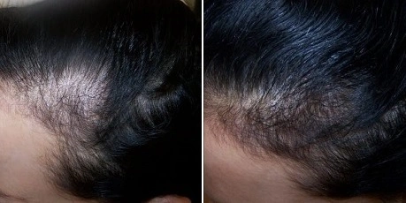 Результаты лечения волос и кожи головы (До | После)