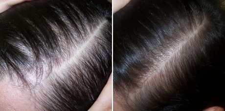 Результаты лечения волос и кожи головы (До | После)