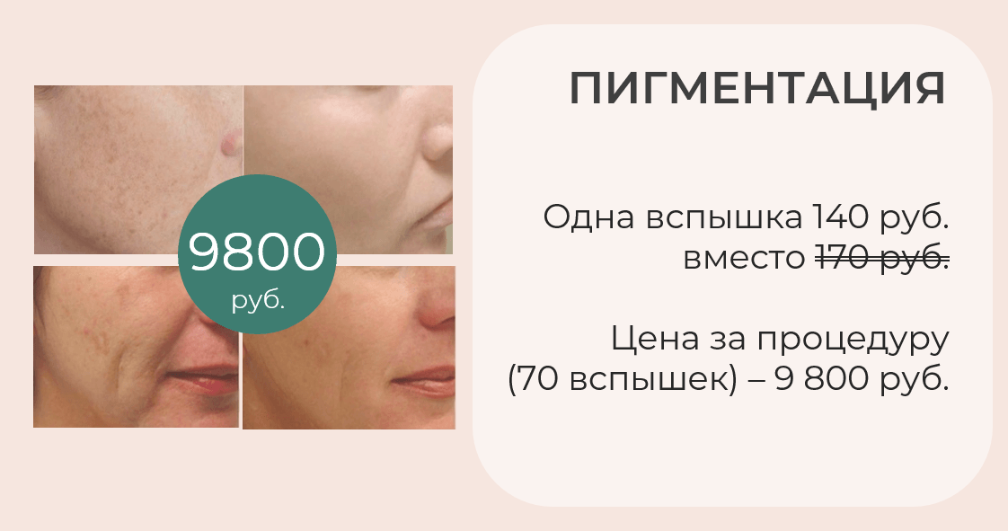 лечение пигментации