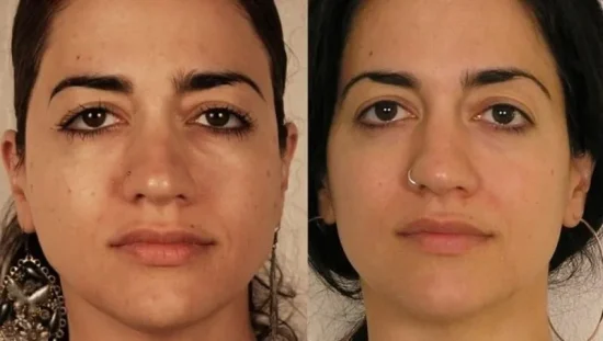 Аппаратная косметология микротоковая терапия фото до и после